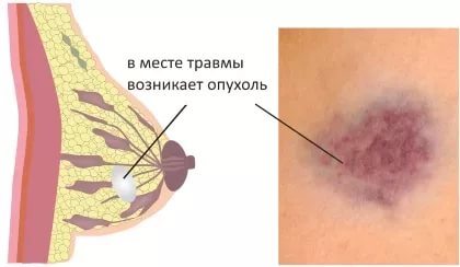 Некроз тканей