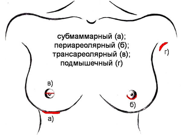 Цены на операцию по подтяжке груди