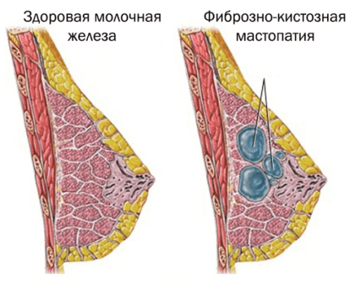 Колет в груди
