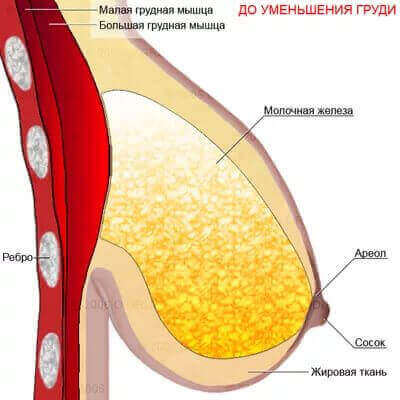 До уменьшения груди