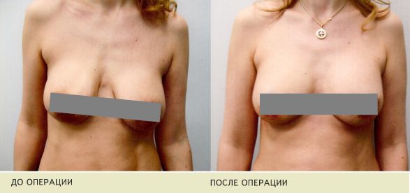 Птоз (обвисание) молочных желез