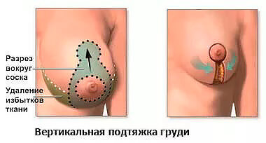 Вертикальная подтяжка груди
