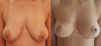 Фото до после подтяжки груди