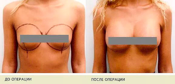 Вертикальная мастопексия