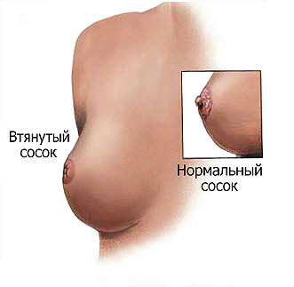 Втянутый сосок