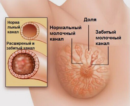 Уплотнение в груди