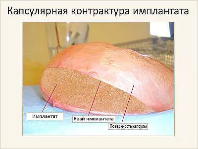 Контрактура импланта