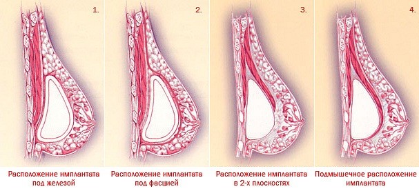 Установка импланта под железу: особенности, преимущества и недостатки метода