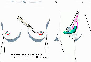 Периареолярный доступ