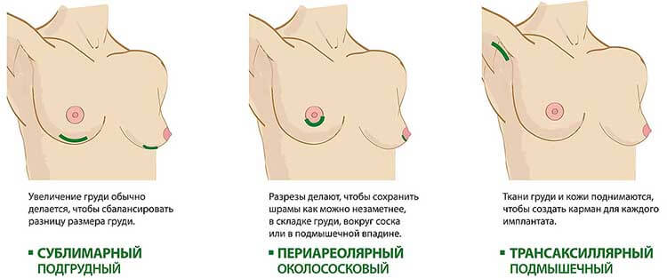 Разрез груди