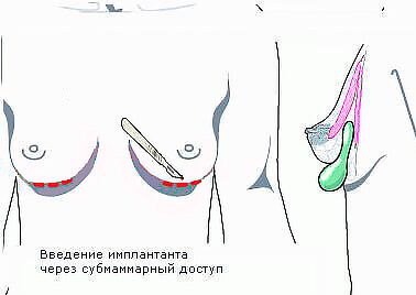 Субмаммарный доступ