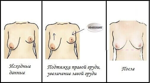 Асимметрия груди