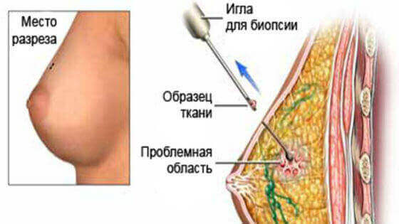 Уплотнение в груди