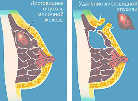 Уплотнение в груди
