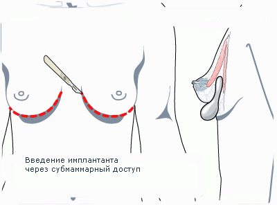 Установка импланта под железу: особенности, преимущества и недостатки метода