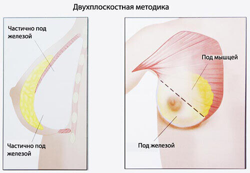 Установка импланта под грудную мышцу: особенности, преимущества и недостатки метода
