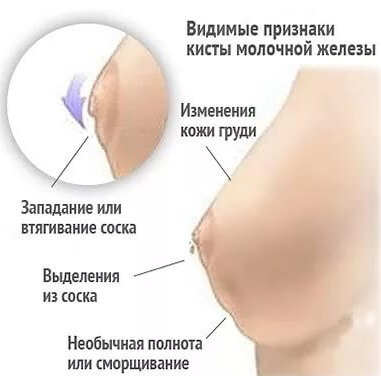 Уплотнение в груди