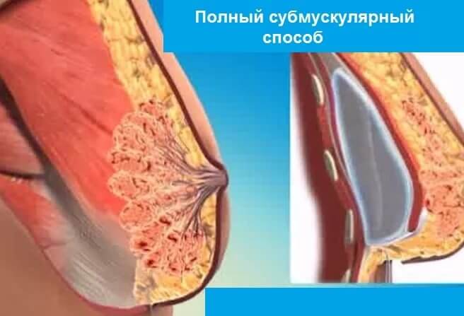Установка импланта под грудную мышцу: особенности, преимущества и недостатки метода