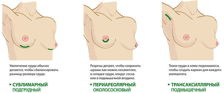 Эндоскопическое увеличение груди