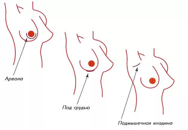 Установка импланта под железу: особенности, преимущества и недостатки метода