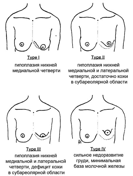 Асимметрия груди