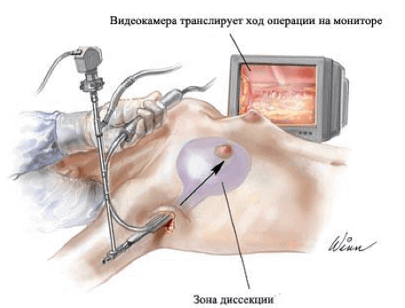 Эндоскопическое увеличение груди