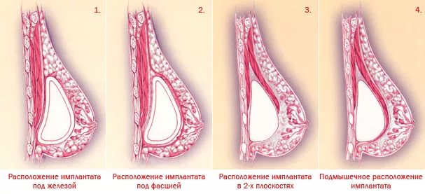 Показания к увеличению груди