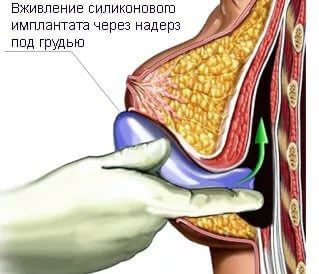 Установка импланта под грудную мышцу: особенности, преимущества и недостатки метода