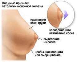 Набухание молочных желез при беременности