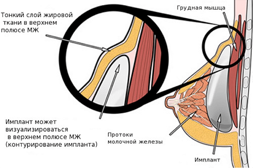 Контурирование