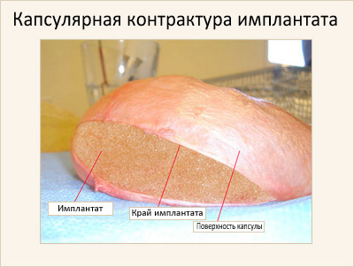 Капсулярная контрактура после маммопластики: симптомы, признаки, лечение