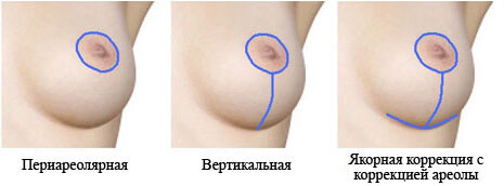 Птоз (обвисание) молочных желез