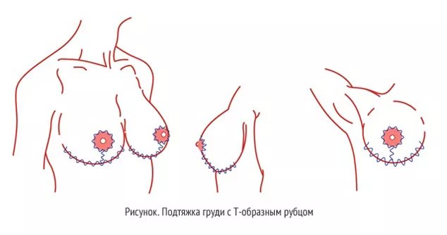Подтяжка груди