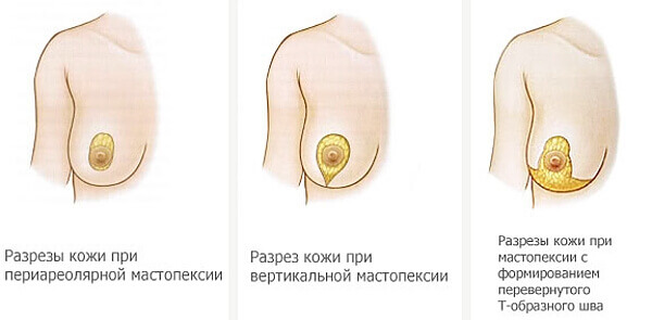 Проведение хирургического разреза