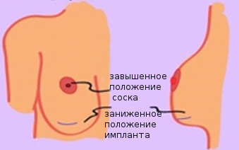 Дабл бабл после увеличения груди