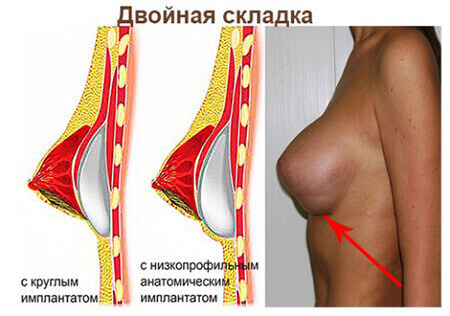 Дабл бабл после увеличения груди