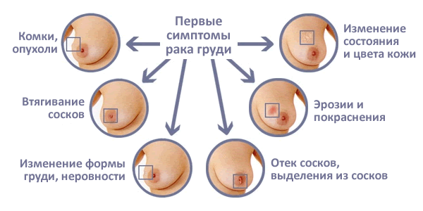 Ноет грудь