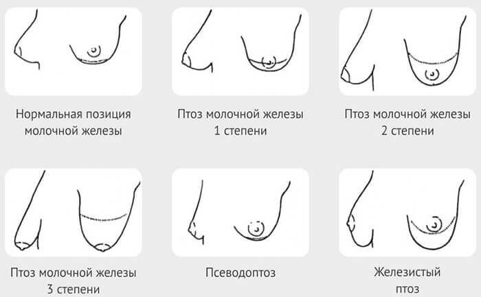 Грудь после родов