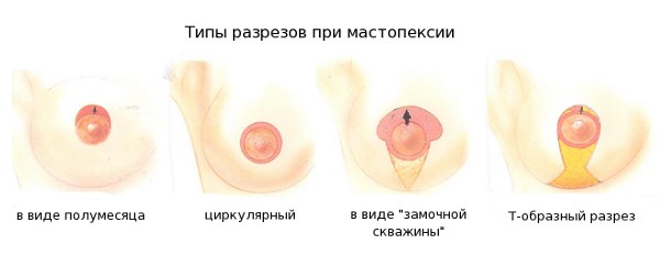 Макромастия (гипермастия, гигантомастия)