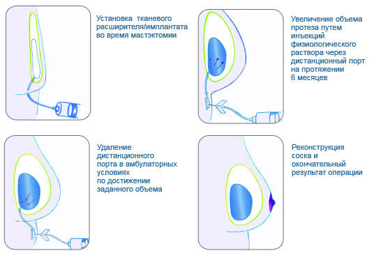 Реконструктивная маммопластика этапы