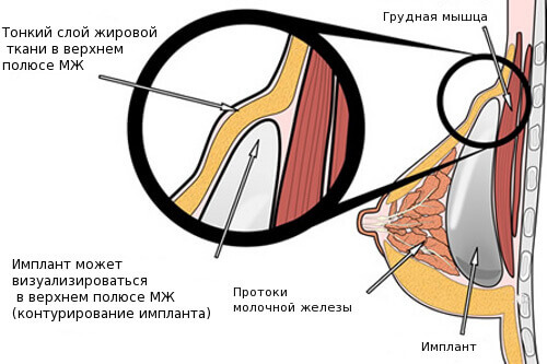 Как проявляется риплинг