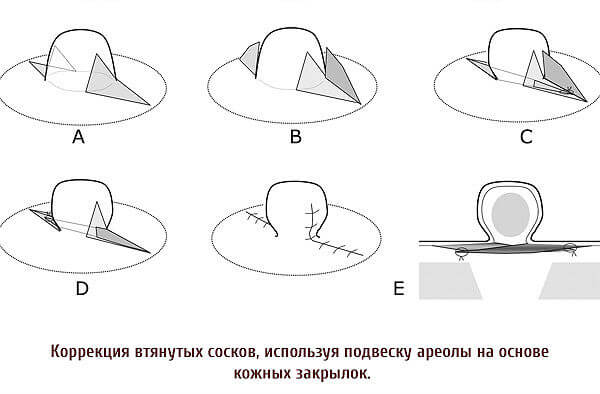 Коррекция сосков