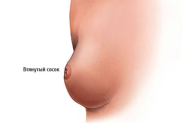 Признаки втянутого соска