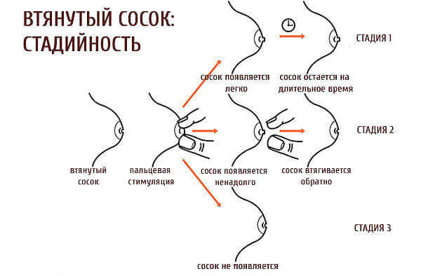 Стадии дефекта
