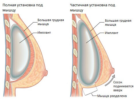 Установка импланта под грудную мышцу: особенности, преимущества и недостатки метода