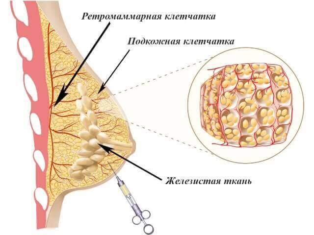 Увеличение груди филлерами (гиалуроновой кислотой)