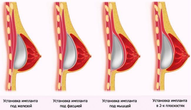 Установка импланта под грудную мышцу: особенности, преимущества и недостатки метода