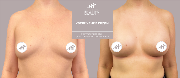 результаты увеличения груди