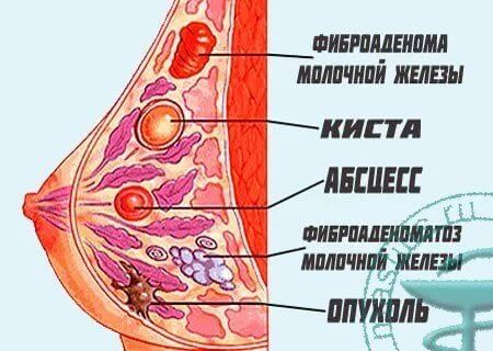 Уплотнение в груди