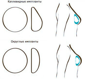 Асимметрия груди